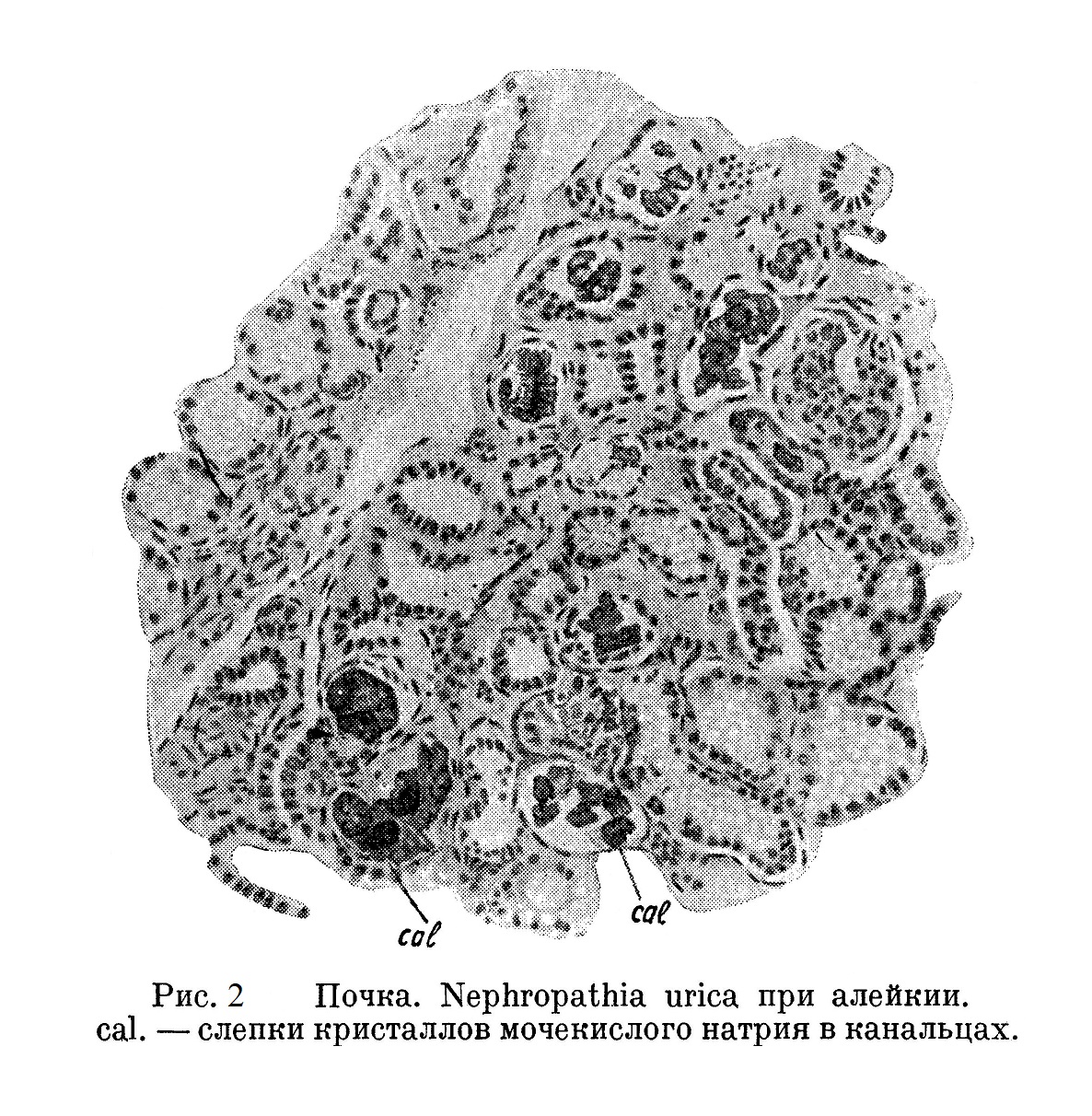 Почка. Nephropathia urica при алейкии. cal. — слепки кристаллов мочекислого натрия в канальцах.