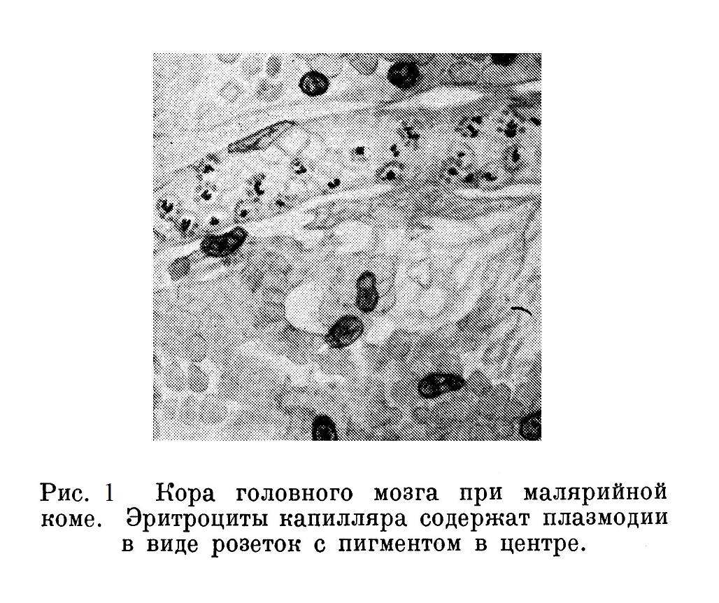 Кора головного мозга при малярийной коме. Эритроциты капилляра содержат плазмодии в виде розеток с пигментом в центре