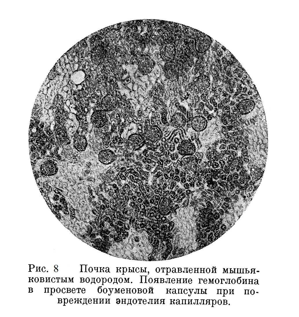 Почка крысы, отравленной мышьяковистым водородом. Появление гемоглобина в просвете боуменовой капсулы при повреждении эндотелия капилляров.