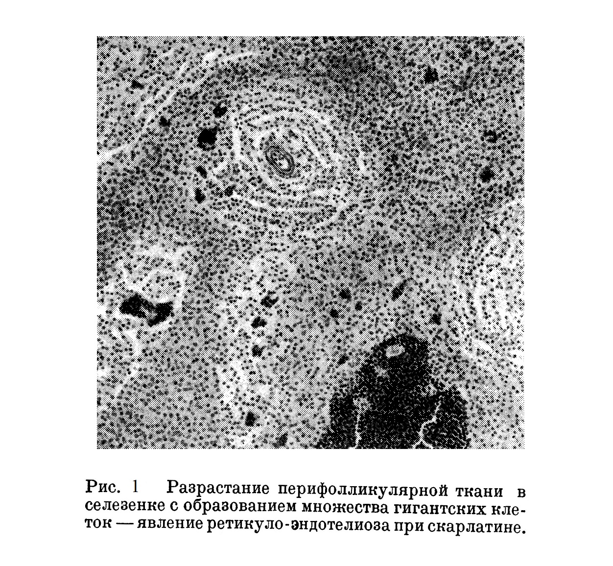 Разрастание перифолликулярной ткани в селезенке с образованием множества гигантских клеток — явление ретикуло-эндотелиоза при скарлатине.