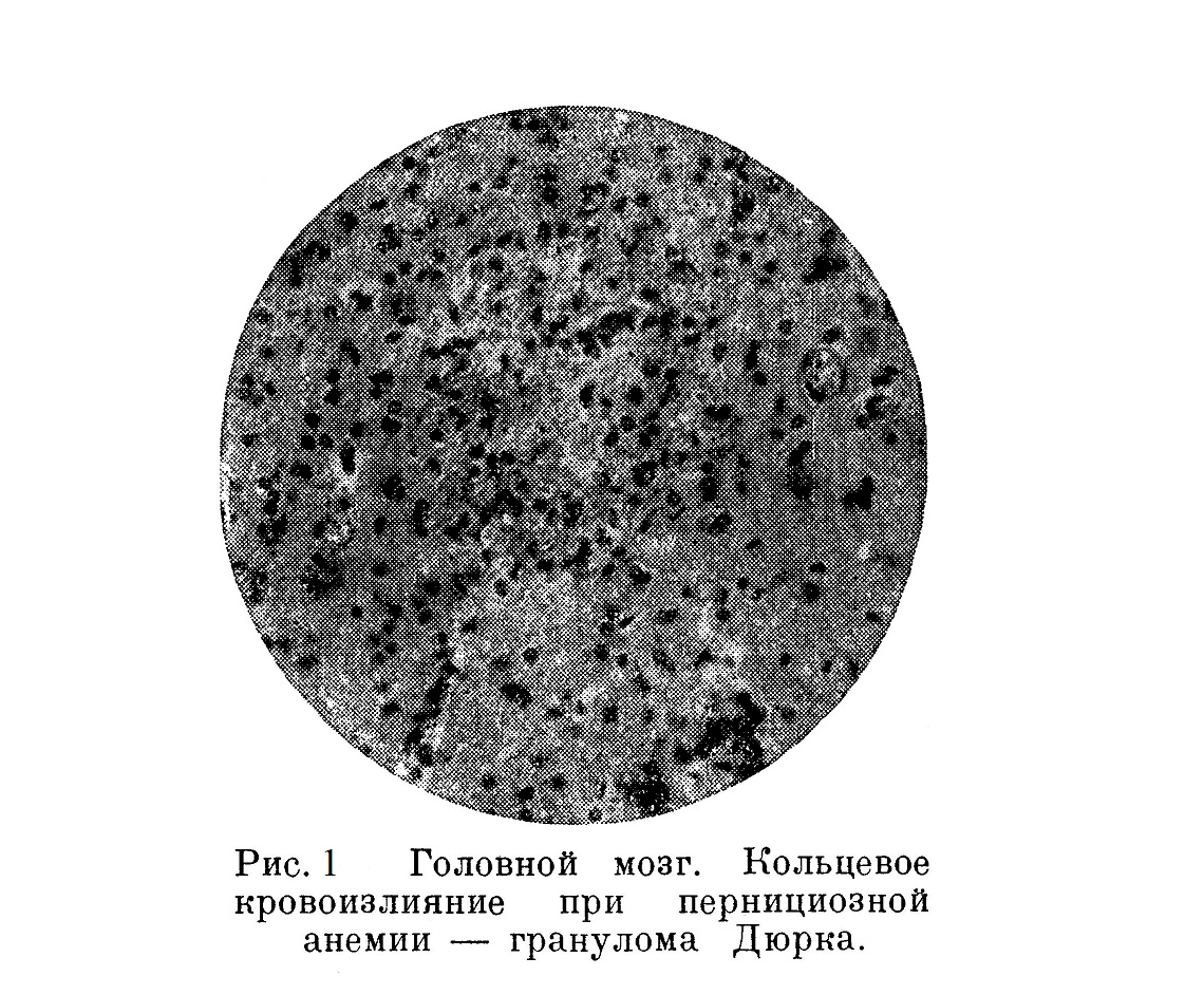 Головной мозг. Кольцевое кровоизлияние при пернициозной анемии — гранулома Дюрка.