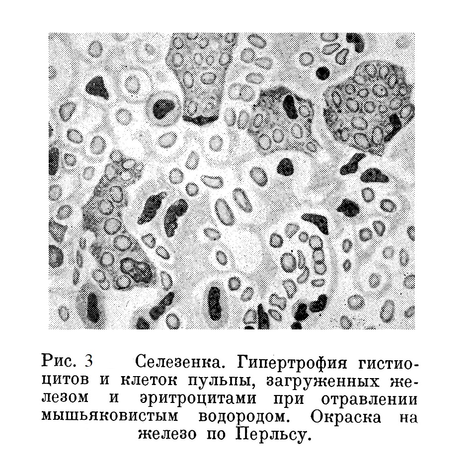 Селезенка. Гипертрофия гистиоцитов и клеток пульпы, загруженных же¬лезом и эритроцитами при отравлении мышьяковистым водородом. Окраска на железо по Перльсу.