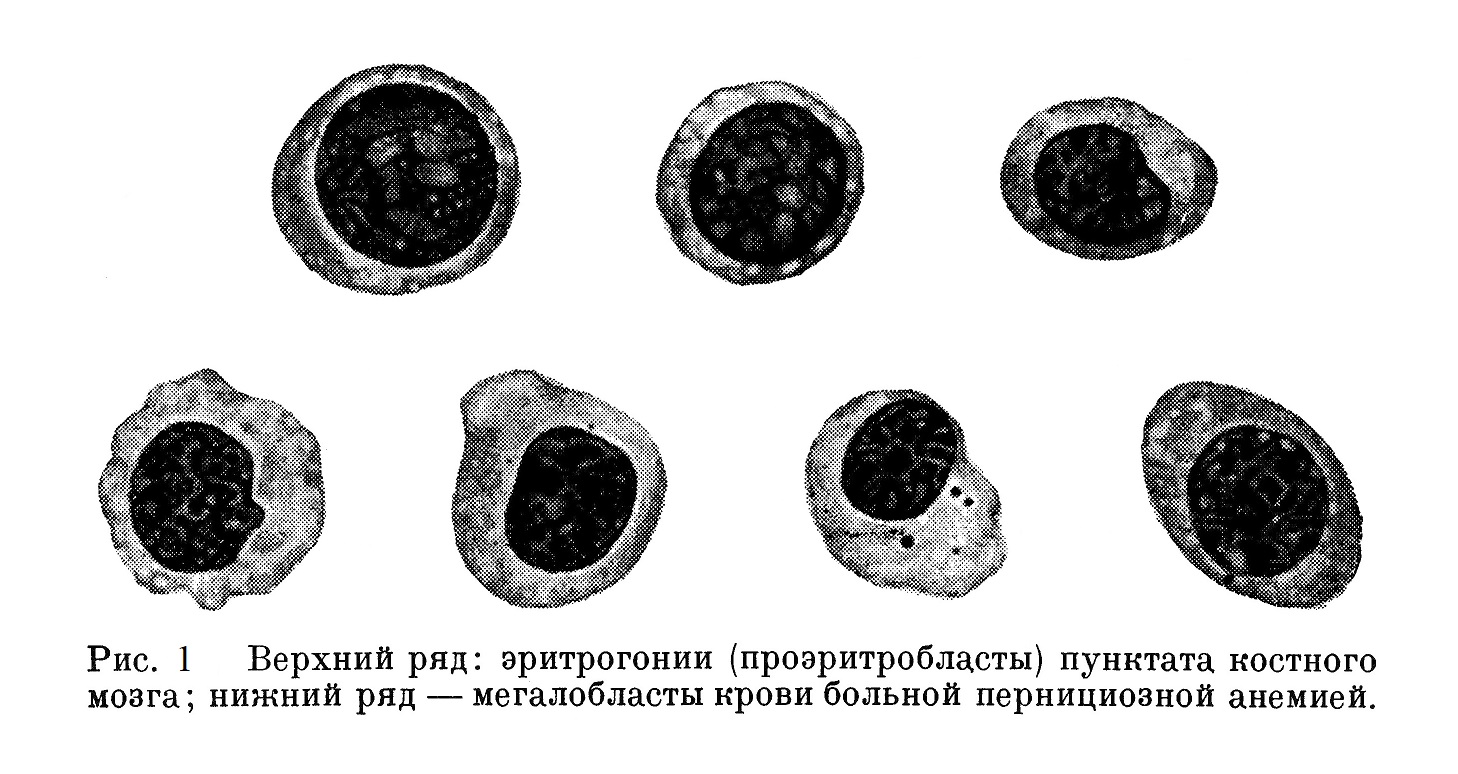 Верхний ряд: эритрогонии (проэритробласты) пунктата костного мозга; нижний ряд — мегалобласты крови больной пернициозной анемией.