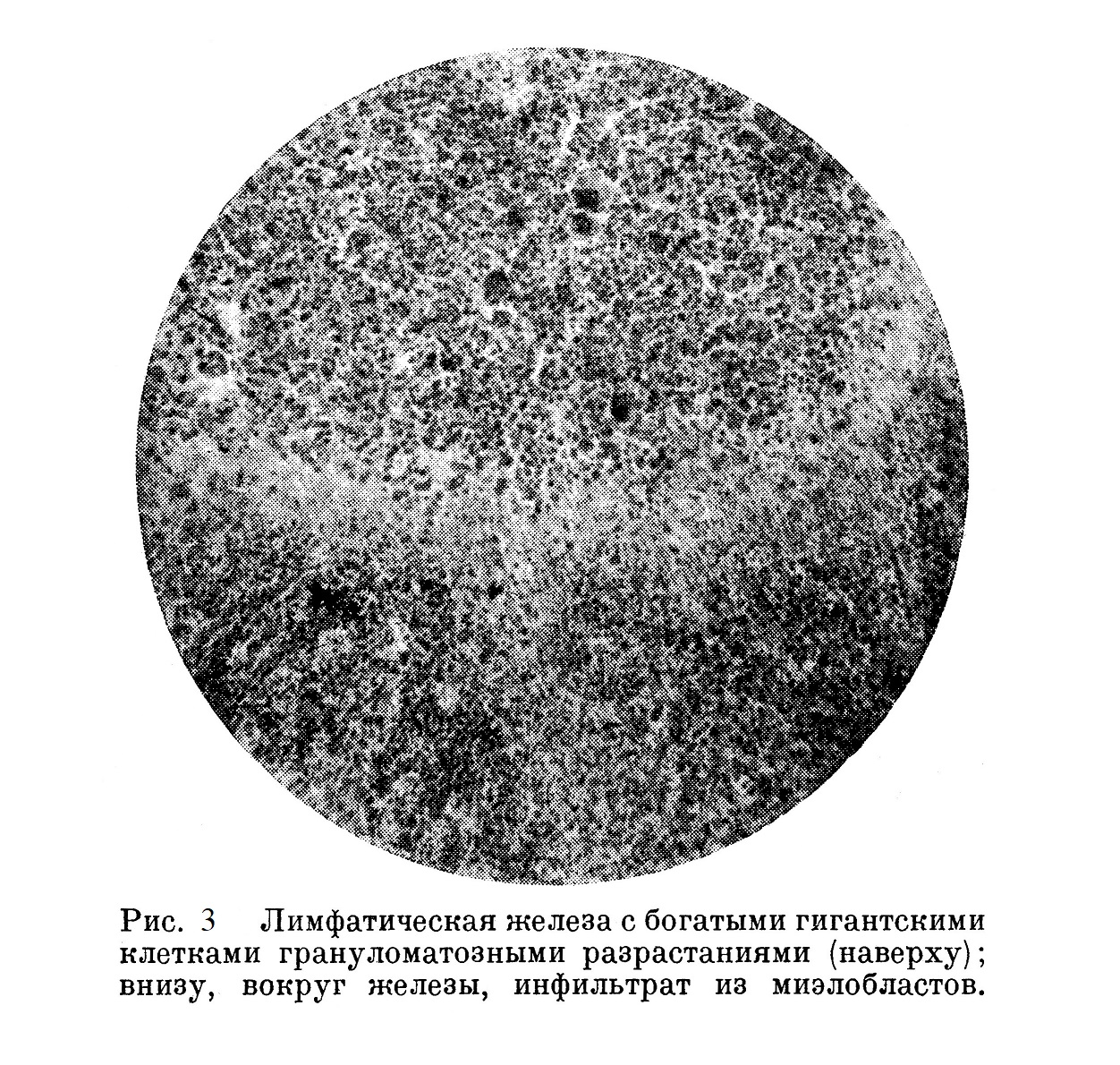 Лимфатическая железа с богатыми гигантскими клетками гранулематозными разрастаниями (наверху); внизу, вокруг железы, инфильтрат из миэлобластов.