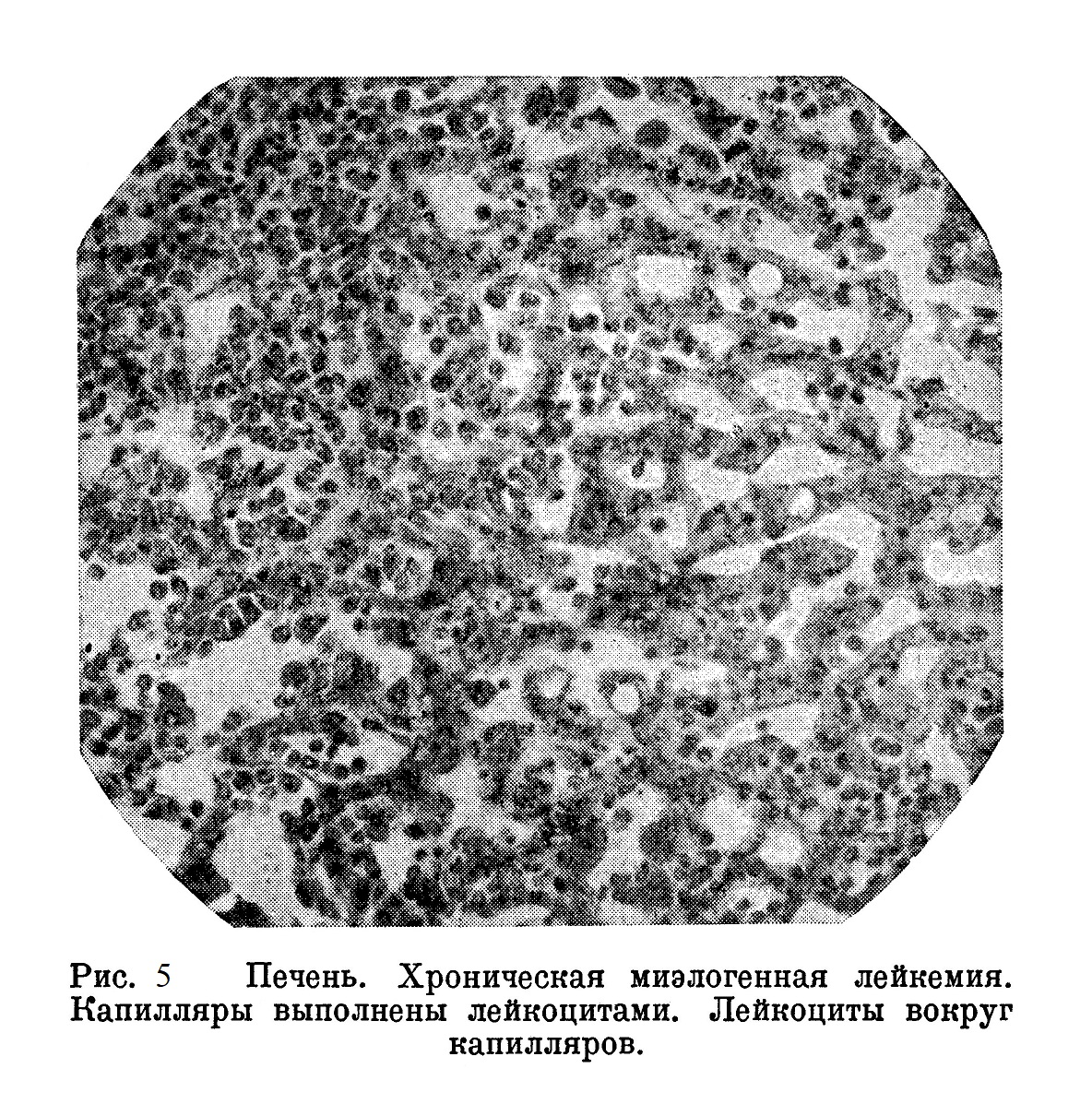 Печень. Хроническая миэлогенная лейкемия. Капилляры выполнены лейкоцитами. Лейкоциты вокруг капилляров.