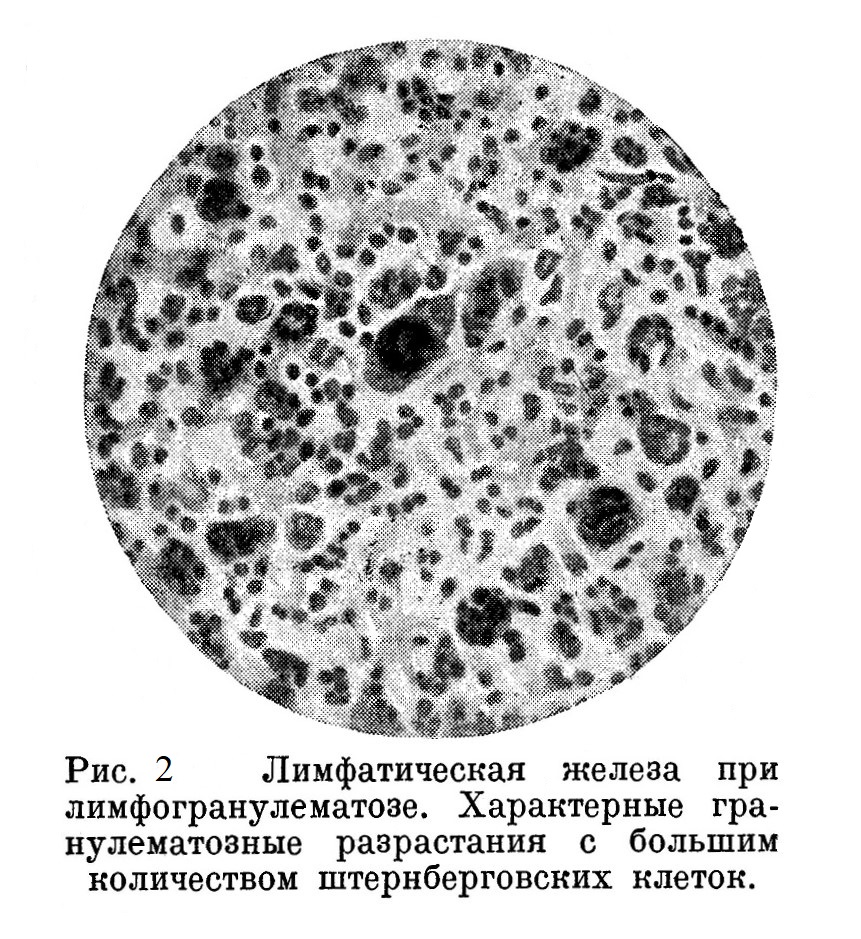 Лимфатическая железа при лимфогранулематозе. Характерные гранулематозные разрастания с большим количеством штернберговских клеток.