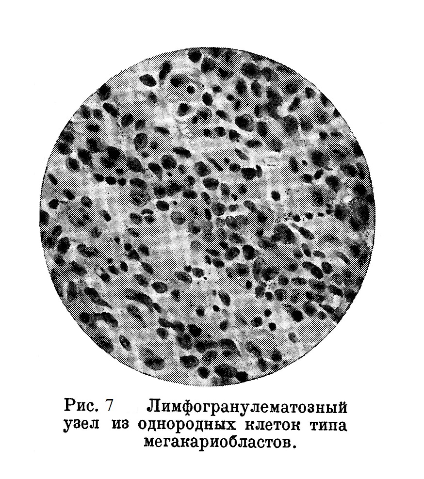 Лимфогранулематозный узел из однородных клеток типа мегакариобластов.