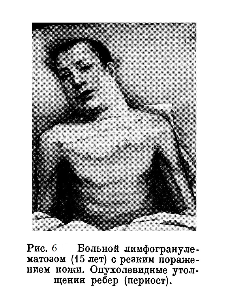 Больной лимфогранулематозом (15 лет) с резким поражением кожи. Опухолевидные утолщения ребер (периост).