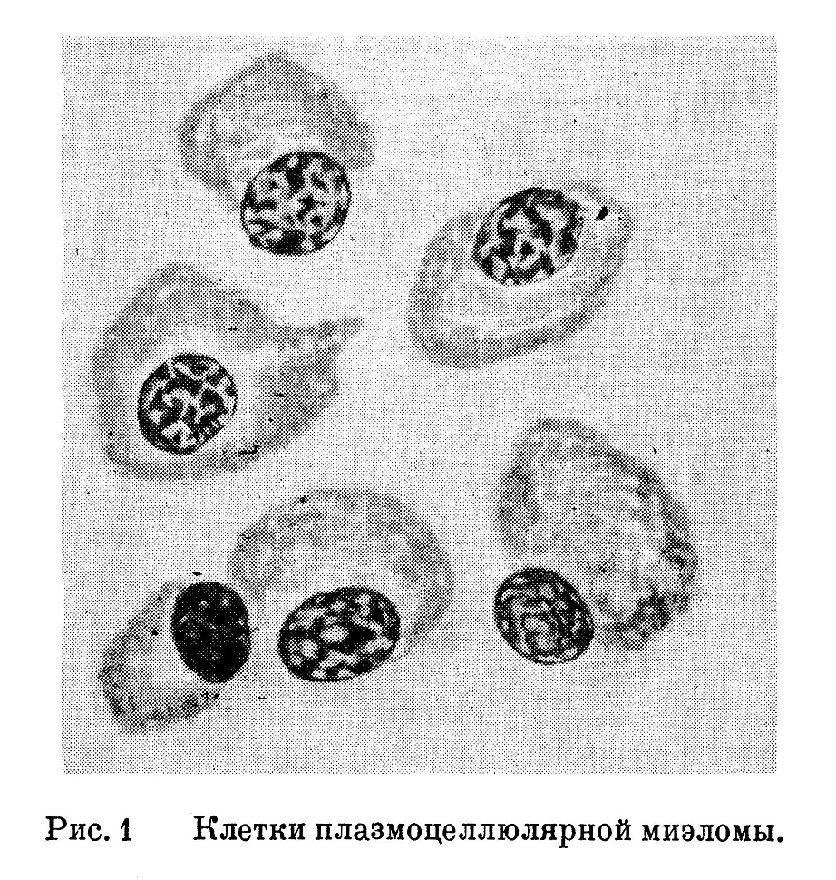 Клетки плазмоцеллюлярной миэломы.