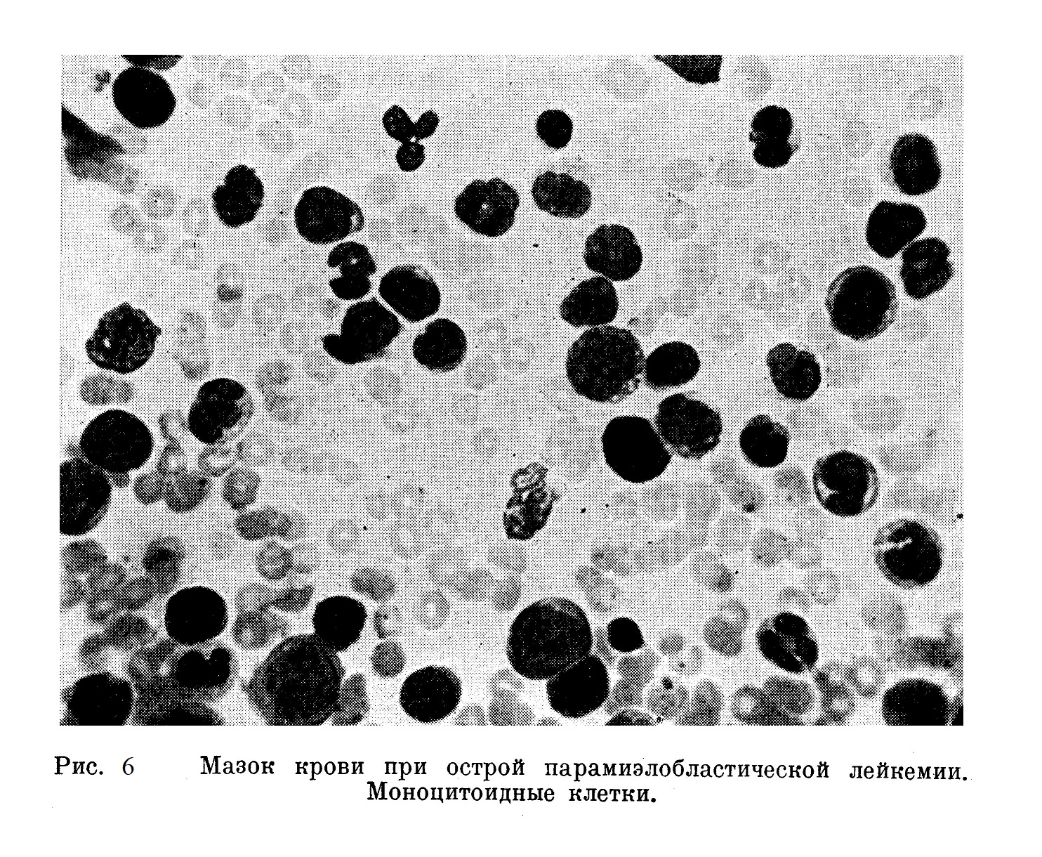 Мазок крови при острой парамиэлобластической лейкемии. Моноцитоидные клетки.
