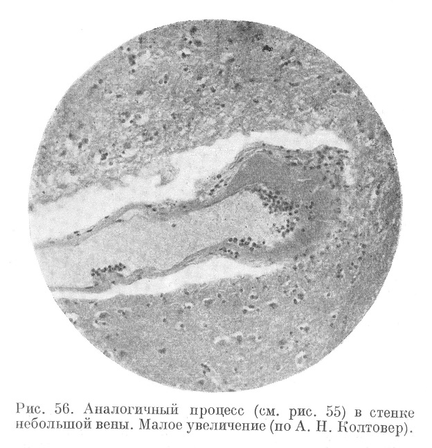 Плазматическое пропитывание и некробиоз на ограниченном участке в небольшой вене 