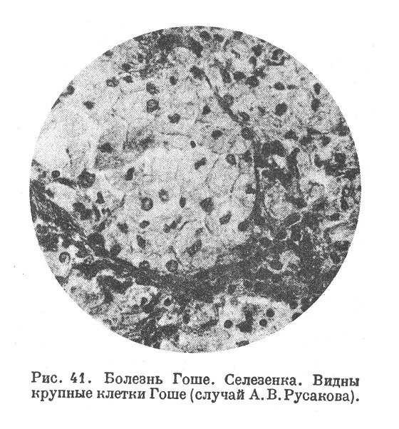 Болезнь Гоше. Селезенка. Видны крупные клетки Гоше (случай А. В. Русакова).