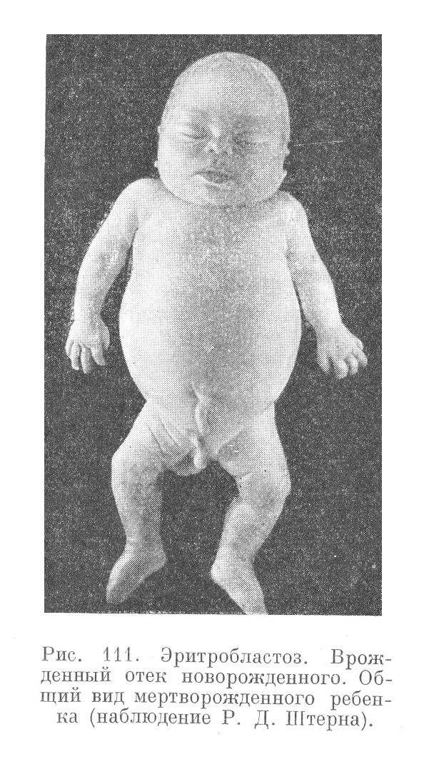  Эритробластоз. Врожденный отек новорожденного. Общий вид мертворожденного ребенка (наблюдение Р. Д. Штерна).