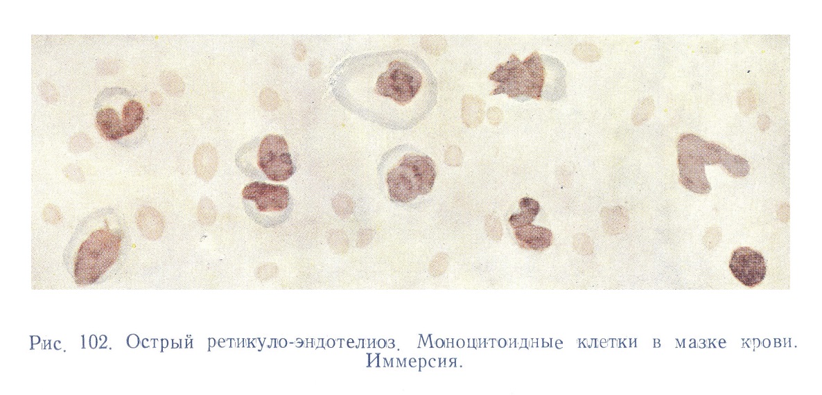 Острый ретикуло-эндотелиоз. Моноцитоидные клетка в мазке крови