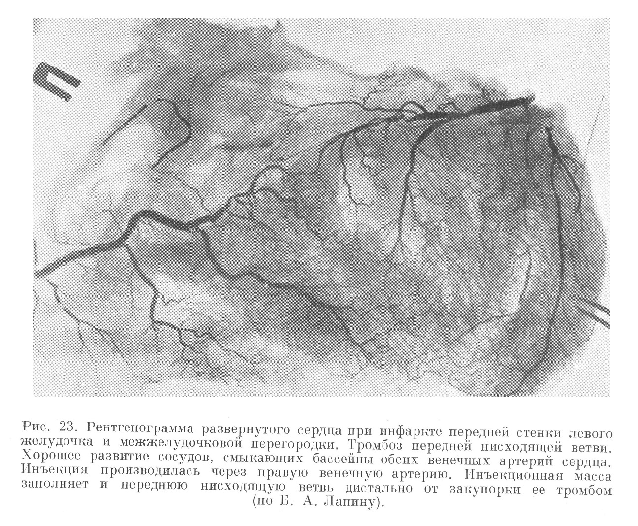 Рентгенография системы венечных артерий сердца