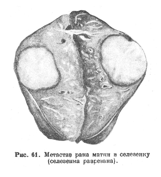 Метастаз рака матка в селезенку (селезенка разрезана).