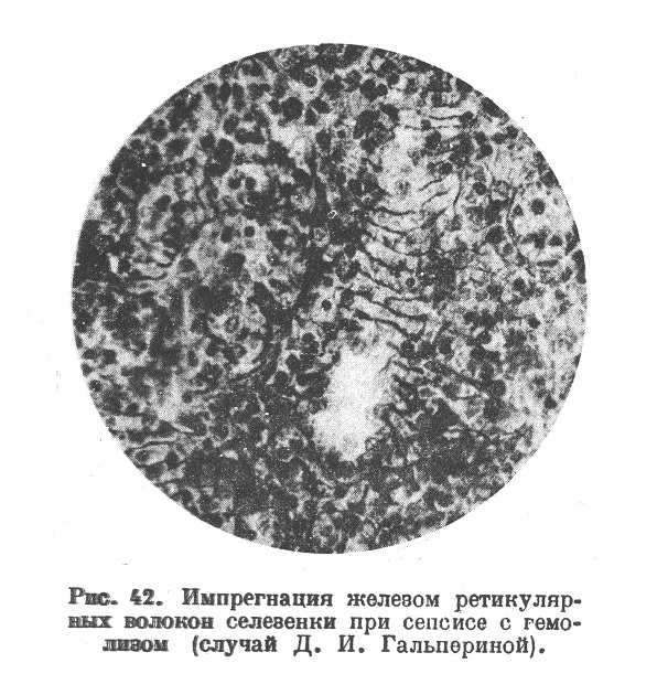 Импрегнация железом ретикулярных волокон селезенки при сепсисе с гемолизом (случай Д. И. Гальпериной).
