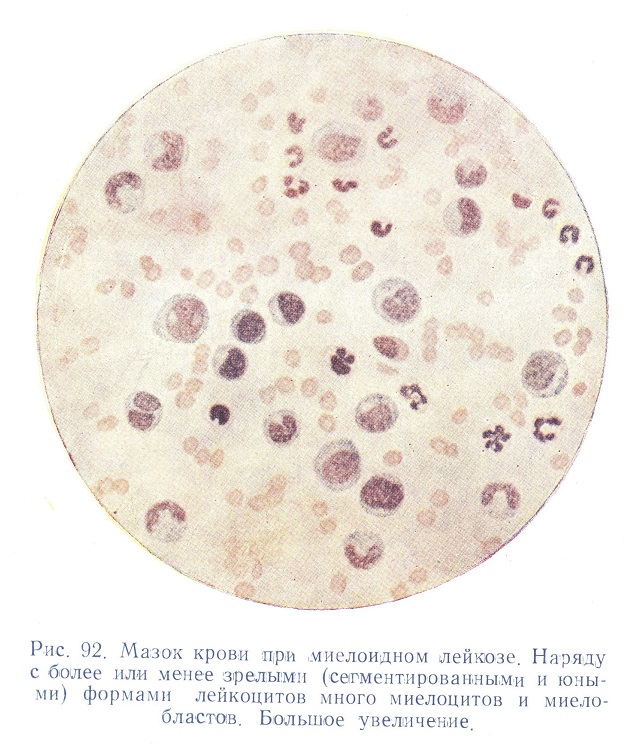 Мазок крови при миелоидном лейкозе