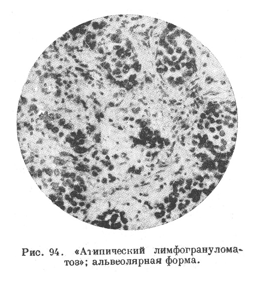 Атипический лимфогрануломатоз, альвеолярная форма