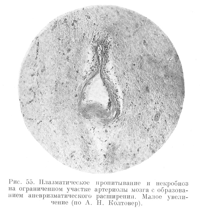 Плазматическое пропитывание и некробиоз на ограниченном участке артериолы мозга с образованием аневризматического расширении. Малое увеличение (по А. Н. Колтовер).
