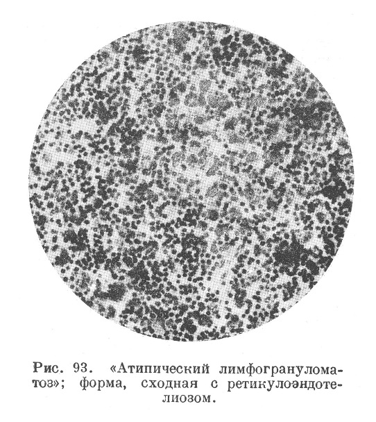 Атипический лимфогрануломатоз»; форма, сходная с ретикулоэндотелиозом.