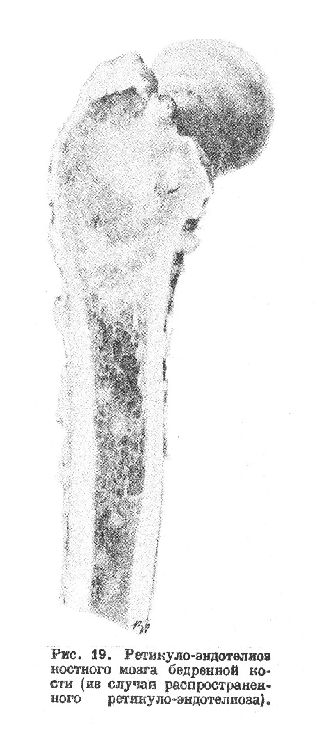 Ретикуло-эндотелиоз костного мозга бедренной кости (из случая распространенного ретикуло-эндотелиоза).