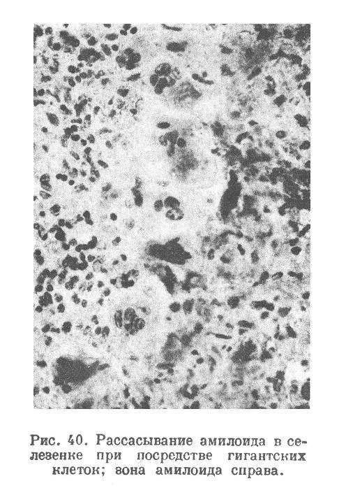 Рассасывание амилоида в селезенке при посредстве гигантских клеток; зона амилоида справа.