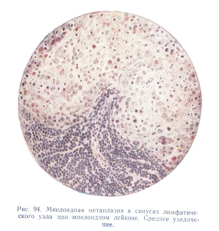 Миелоидная метаплазия в синусах лимфатического узла при миелоидном лейкозе