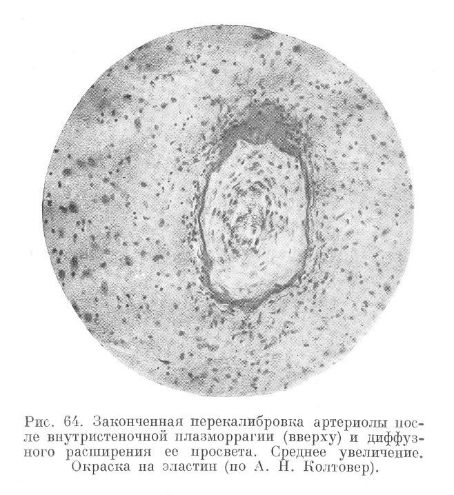 Законченная перекалибровка артериолы после внутристеночной плазморрагии (вверху) и диффузного расширения ее просвета. Среднее увеличение. Окраска на эластин (по А. Н. Колтовер).