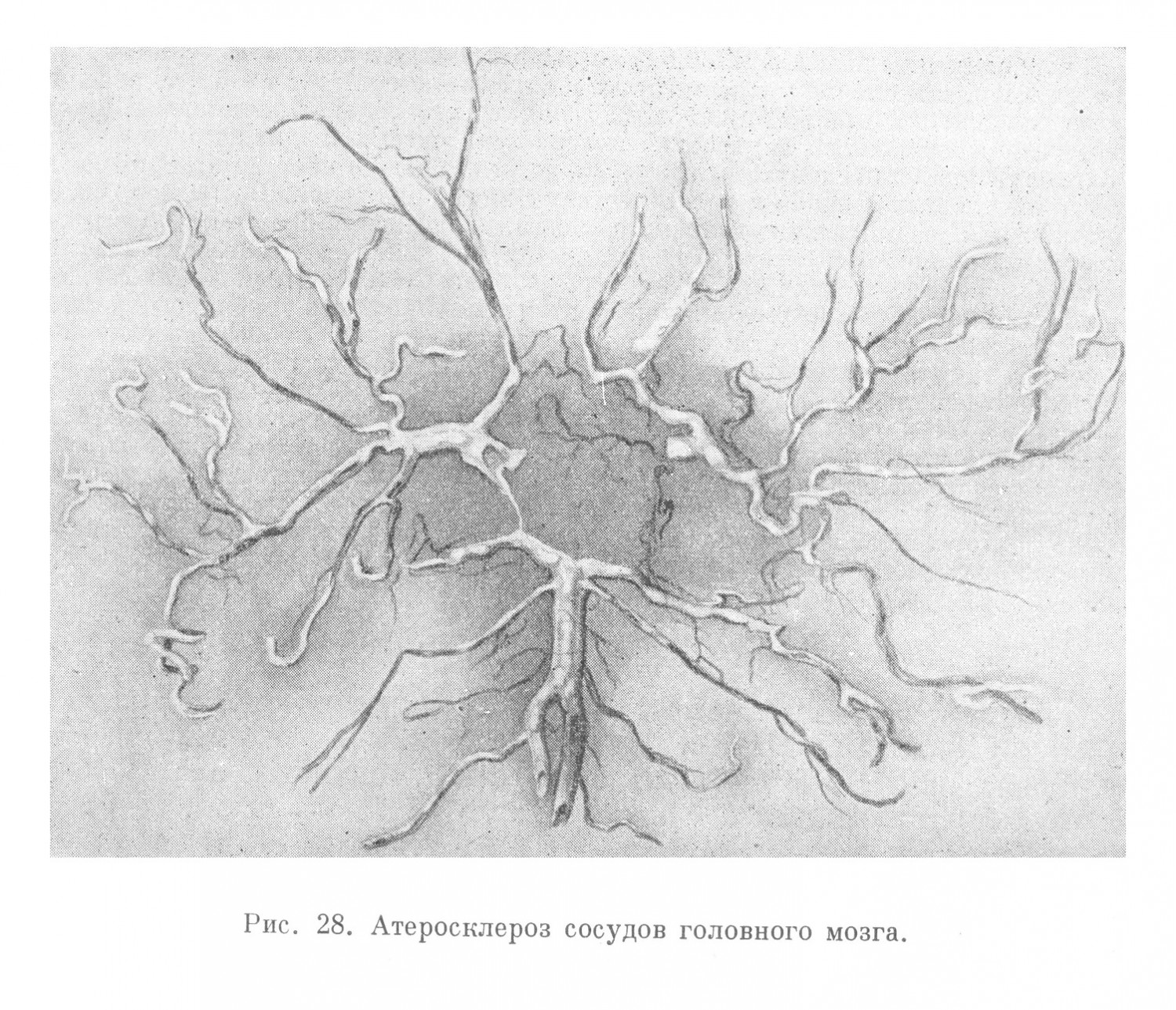 Атеросклероз сосудов головного мозга