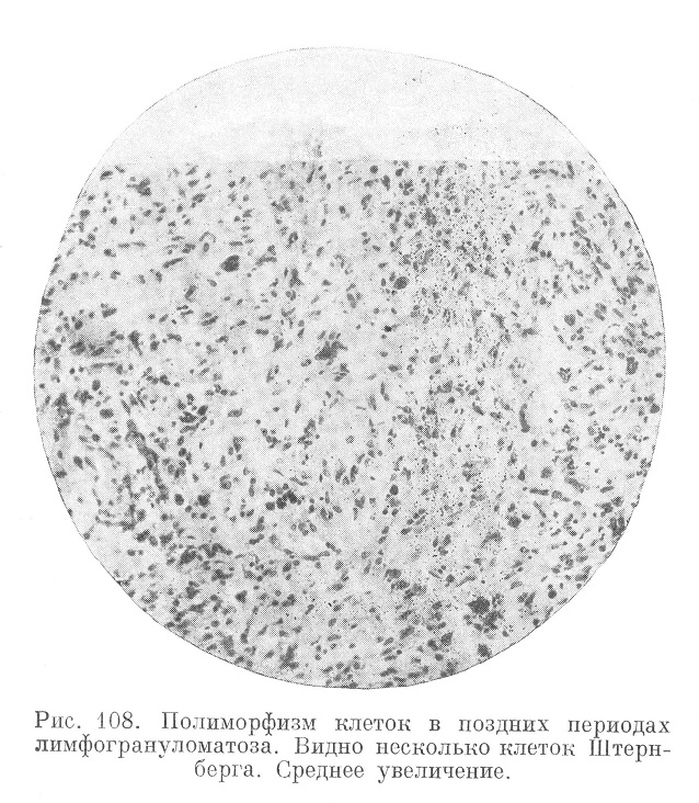 Полиморфизм клеток в поздних периодах лимфогрануломатоза. Видно несколько клеток Штернберга. Среднее увеличение. 