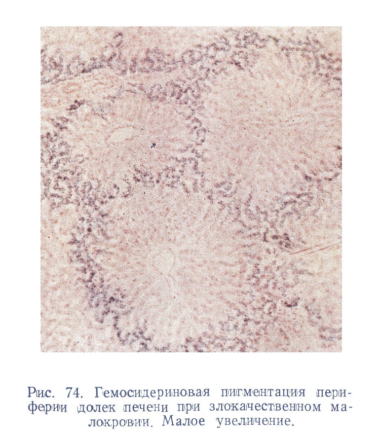 Гемосидериновая пигментация периферии долек печени при злокачественном малокровии