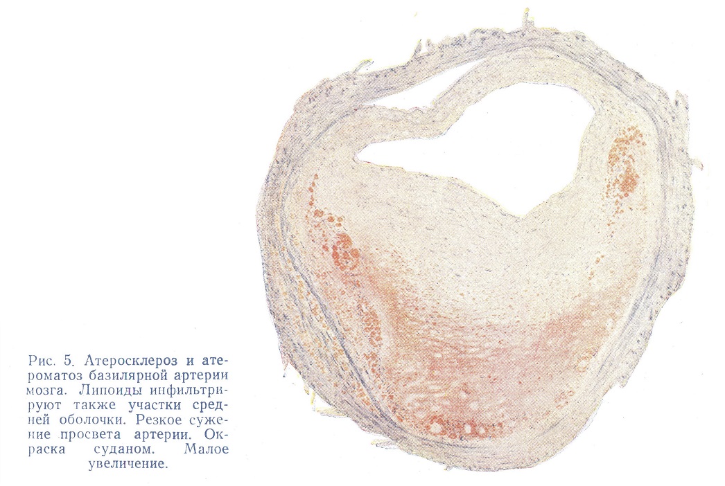 Атеросклероз и атероматоз базилярной артерии мозга