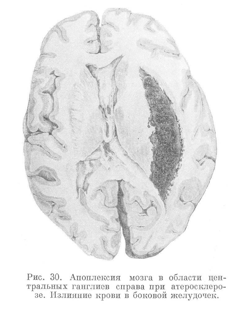 Апоплексия мозга в области центральных ганглиев справа при атеросклерозе. Излияние крови в боковой желудочек.