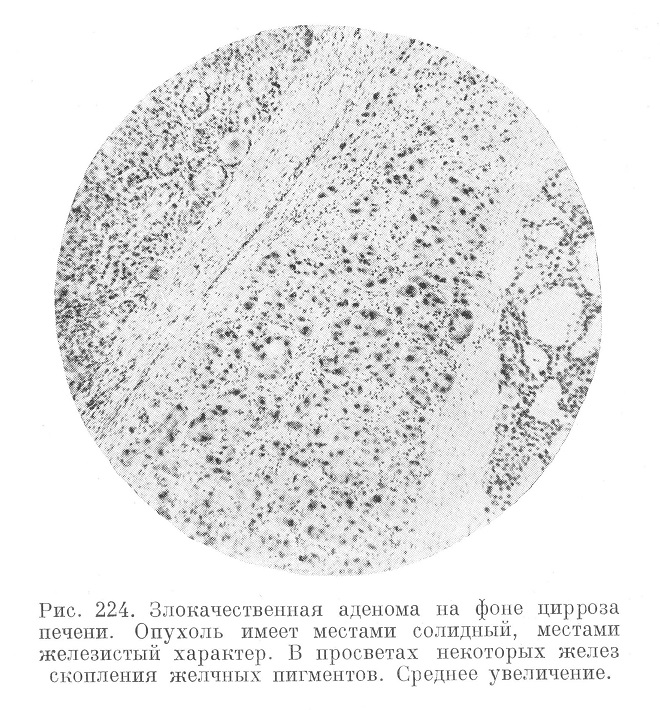 Злокачественная аденома на фоне цирроза печени