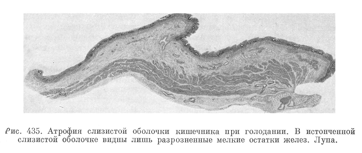 Атрофия слизистой оболочки кишечника при голодании. В истонченной слизистой оболочке видны лишь разрозненные мелкие остатки желез. Лупа.