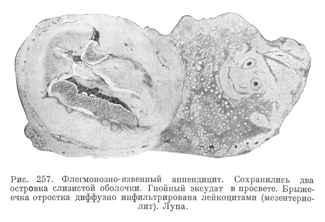 Флегмонозно-язвенный аппендицит. Сохранились два островка слизистой оболочки. Гнойный эксудат в просвете. Брыже- ечка отростка диффузно инфильтрирована лейкоцитами (мезентериолит). Лупа.