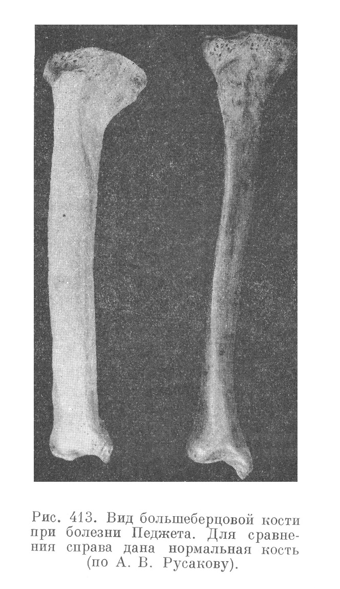 Вид большеберцовой кости при болезни Педжета. Для сравнения справа дана нормальная кость (по А. В. Русакову).