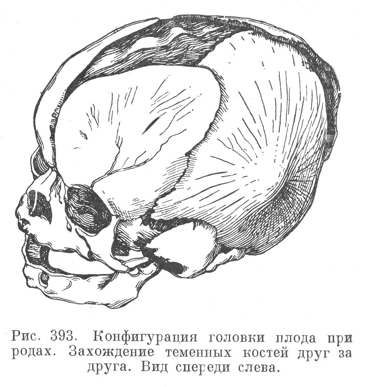 Конфигурация головки плода при родах. Захождение теменных костей друг за друга. Вид спереди слева.