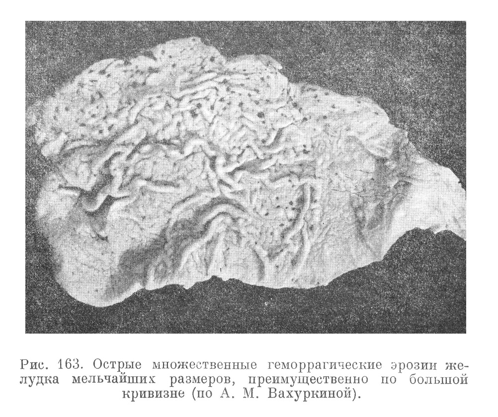 Острые множественные геморрагические эрозии желудка мельчайших размеров, преимущественно по большой кривизне (по А. М. Вахуркиной).