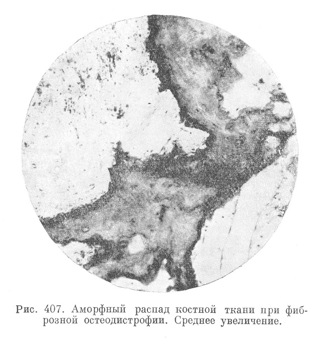 Аморфный распад костной ткани при фиброзной остеодистрофии. Среднее увеличение. 