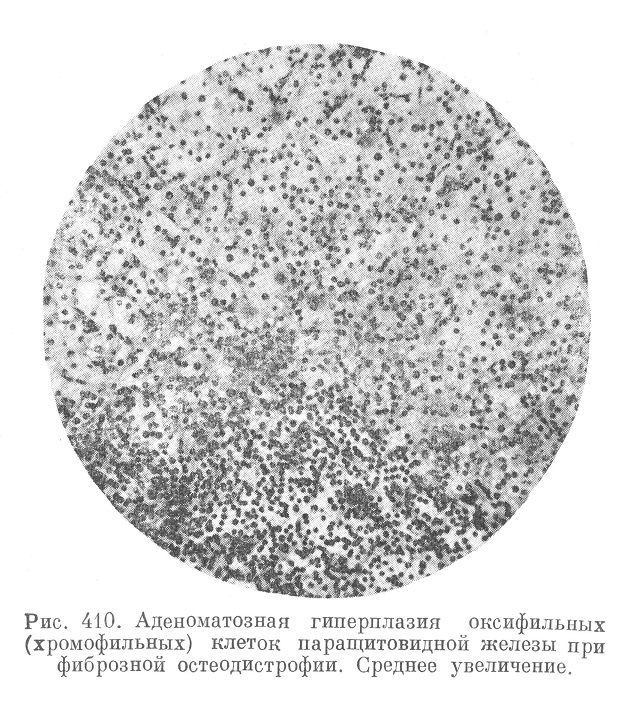 Аденоматозная гиперплазия оксифильных (хромофильных) клеток паращитовидной железы при фиброзной остеодистрофии. Среднее увеличение