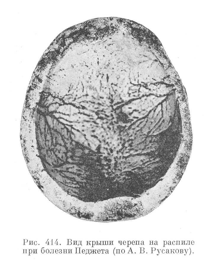 Вид крыши черепа на распиле при болезни Педжета (по А. В. Русакову)