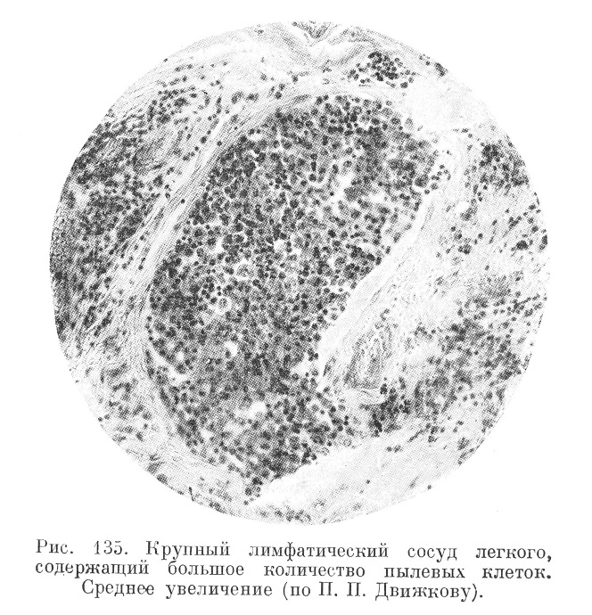 Крупный лимфатический сосуд легкого, содержащий большое количество пылевых клеток. Среднее увеличение (по П. П. Движкову).