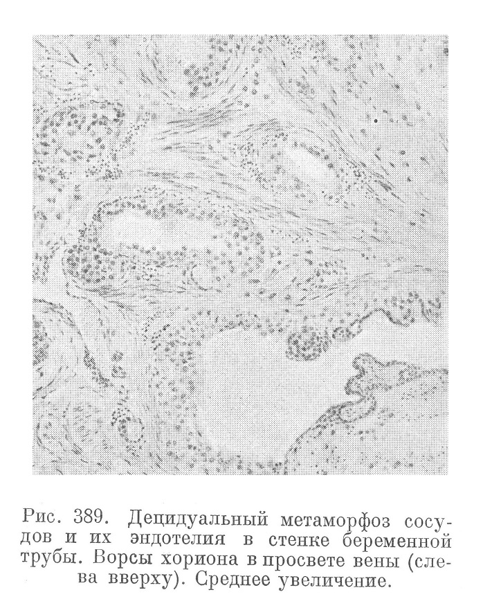 Децидуальный метаморфоз сосудов и их эндотелия в стенке беременной трубы. Ворсы хориона в просвете вены (слева вверху). Среднее увеличение.