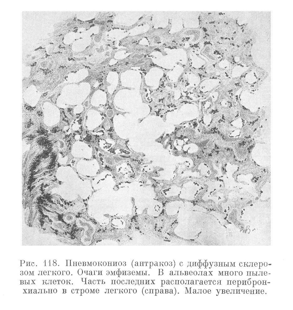 Пневмокониоз (антракоз) с диффузным склерозом легкого. Очаги эмфиземы. В альвеолах много пылевых клеток. Часть последних располагается перибронхиально в строме легкого (справа). Малое увеличение.
