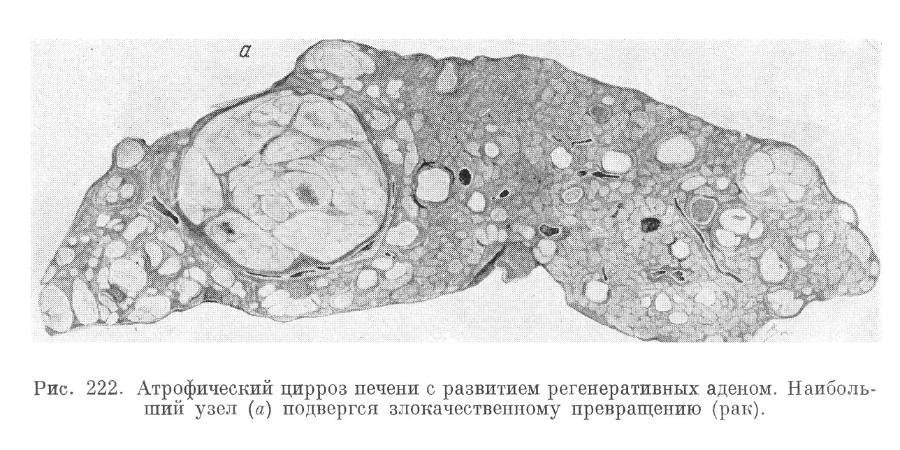 Атрофический цирроз печени с развитием регенеративных аденом. Наибольший узел (а) подвергся злокачественному превращению (рак).