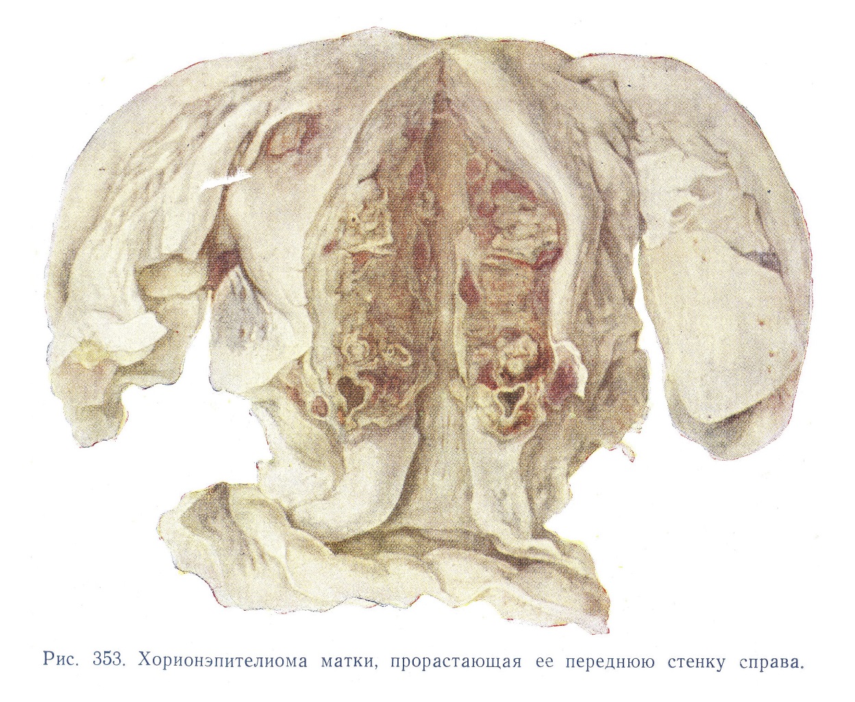 Хорионэпителиома матки, прорастая ее переднюю стенку справа