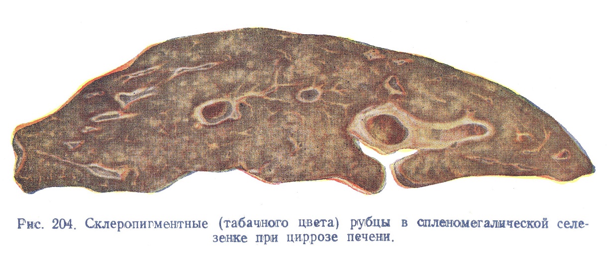 плотные склеропигментные рубцы цвета ржавчины («табачные узелки», или узелки Ганди-Гамна), оказывающиеся ожелезненными рубцами при циррозе печени