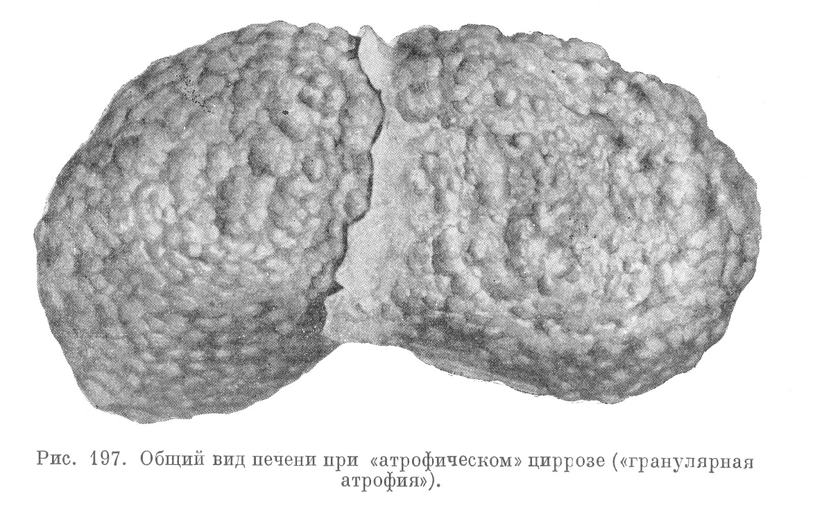 Общий вид печени при «атрофическом» циррозе («гранулярная атрофия»).